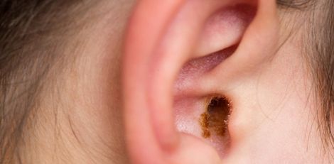 Earwax Buildup and Blockage