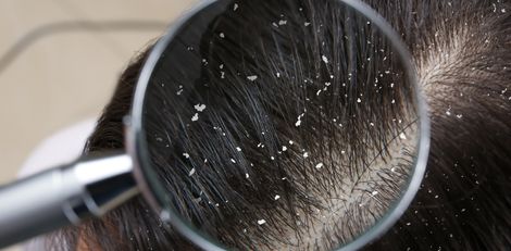 Home Remedies to Get Rid of Dandruff Naturally