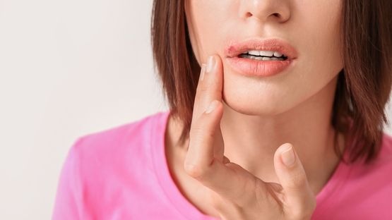 What Are Cold Sores? Symptoms, Causes & Treatment