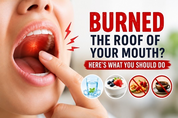 Burned the Roof of Your Mouth? Here’s What You Should Do